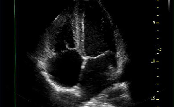 飞依诺彩超四腔心切面