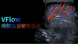 VFLOW分享|新生儿颅内血管的敏感显示