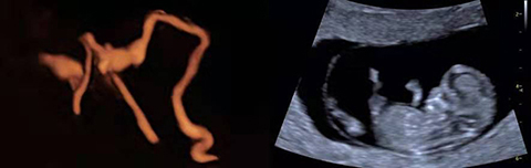 输卵管容积造影，二维早孕筛查