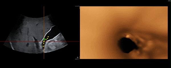 使用飞依诺彩色超声诊断仪VNavln 3D功能观察胆囊息肉
