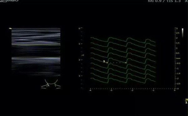 应用M80进行颈动脉局部脉搏波传导速度检测