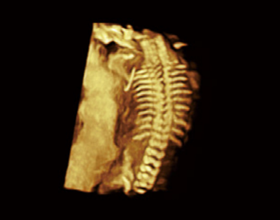 胎儿脊柱